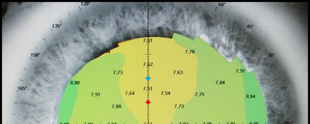 Figur 7. Topogram, vilken visar absolut skala. En linjal kan även ses, som finns att välja i programmet. Linjalen kan användas för att jämföra precisa lägen på cornea.