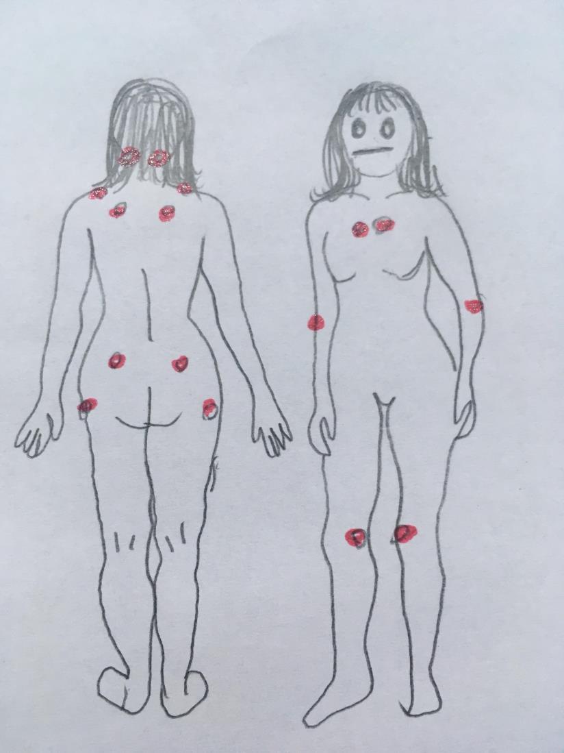 Figur 1. ACR-Kriteriernas Tenderpoints. Behandling Enligt Lesley m.fl. (2017) finns det inget botemedel så behandlingen av fibromyalgi är inriktad på att lindra symtomen.