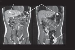Clin Pract 2013 Differential Effects of FODMAPs (Fermentable Oligo-, Di-, Mono-Saccharides and Polyols) on Small and Large Intestinal Contents in Healthy Subjects Shown by MRI Murray,