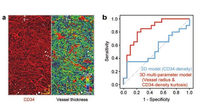 (a) Volym rendering av 3D-mikroskopi-data från en 87-årig man med icke-muskelinvasiv urinblåsecancer. Blodkärlen är infärgade med en antikropp mot CD34.