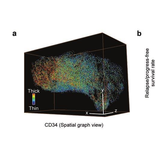 Figur 3. (a) Volym-rendering av 3D-mikroskopi-data från äggstockscancer med platinum-resistens. Blodkärlen är infärgade med en antikropp mot CD34.