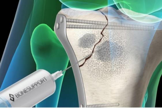 Om bolaget Bonesupport Holding AB (publ.) (Bonesupport eller Bolaget) utvecklar och säljer produkter för behandling av hålrum i ben.