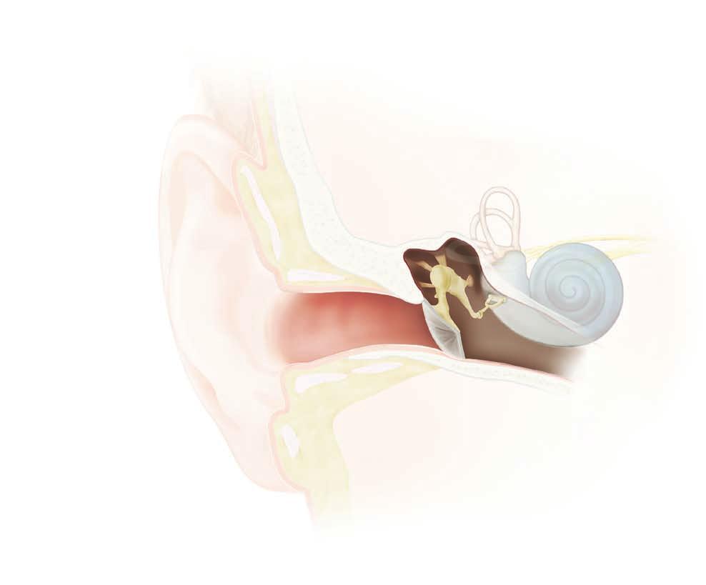 Så fungerar vanlig hörsel Den naturliga hörseln är en kedja av händelser som följer på varandra: 1 Ljudet fortplantas som ljudvågor som träffar ytterörat och via hörselgången når trumhinnan.