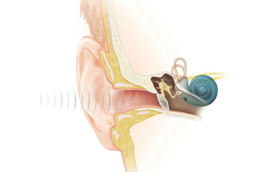 i hjärnan, där de tolkas som ljud. Snäcka (Cochlea) Hörselnedsättning En person har en när han eller hon inte har normal känslighet för ljud. Det finns olika typer av.