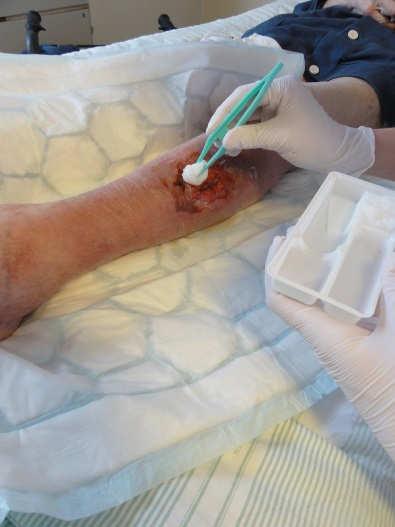 Såromläggning en smittspridningsrisk? Bristande följsamhet till basala hygienrutiner och städning samt överförbrukning av antibiotika, ökar smittspridningsrisken av bakterier.