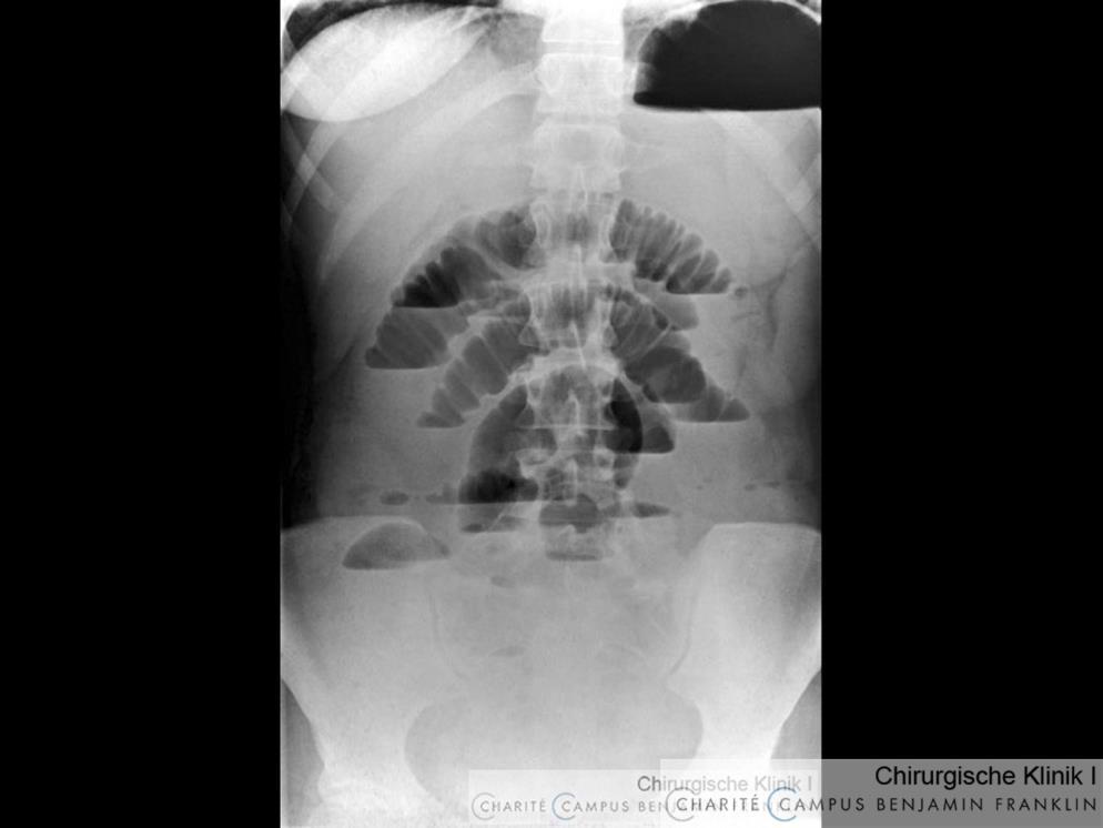 Ileus röntgenutredning