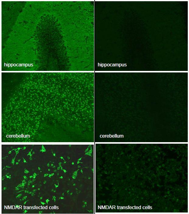 Anti-NMDA Ab