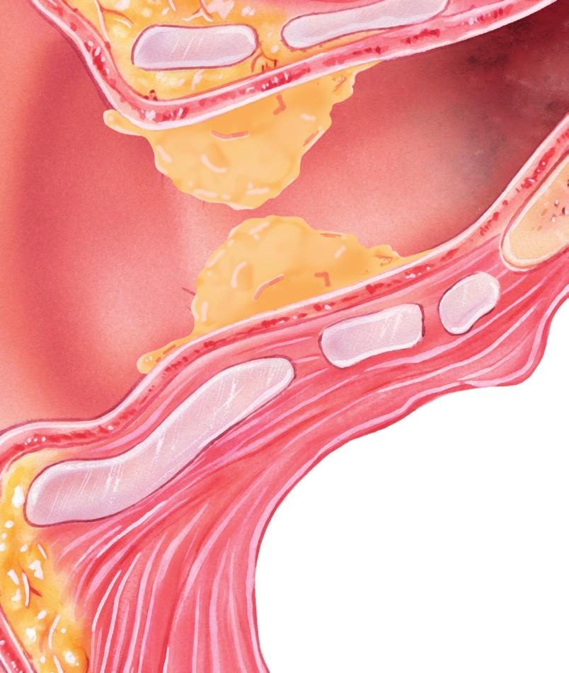 Öronvax & vaxproppar Det finns en myt att öronvax är smutsigt, men öronvax är helt normalt och viktigt för att örat ska fungera väl. Vad är öronvax och vaxproppar?