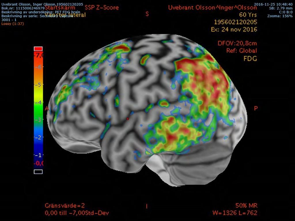 PET vid typisk Alzheimers sjukdom: nedsatt glukosupptag i bakre hjäss- och