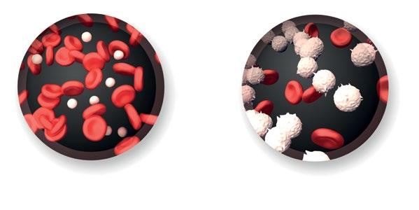 INLEDNING VAD ÄR ALL? lall är en typ av blodcancer i vilken benmärgen tillverkar för många blodproducerande celler. Dessa celler är omogna former av vita blodkroppar.