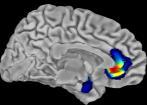 DCD komorbiditet NDD: ADHD (50%), ASD (4-8%)