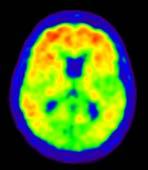 Det finns också ett stort behov av bättre och mer specifika diagnostiska metoder för att kunna ställa rätt diagnos i ett tidigare skede och därmed möjliggöra tidigare behandling samt för att följa
