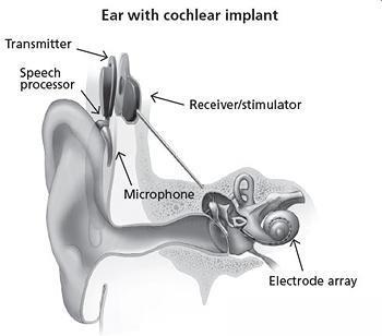 Figur 3: Cochleaimplantat Källa: https://www.nidcd.nih.gov/health/cochlear-implants Den vanligaste operationstekniken är via en mastoidektomi.