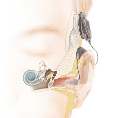 1.5.3 Kombinerad elektrisk och akustisk stimulering EAS är en rehabiliteringmetod inom hörselrehabilitering för de personer med svår-grav sensorineural hörselnedsättning i högfrekvensområdet men med