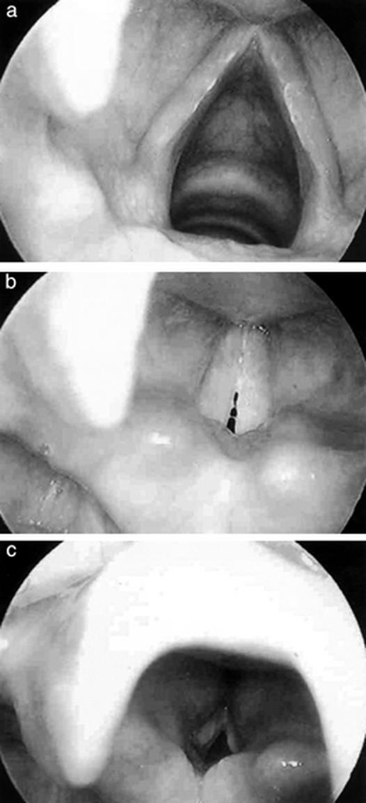 Vocal cord