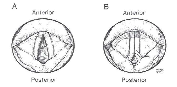 (paradoxal