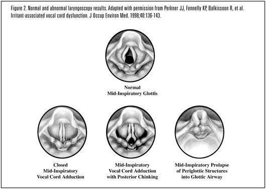 Exercice-Induced Laryngeal Obstructions (EILOs) Paradoxal stämvecksrörlighet (