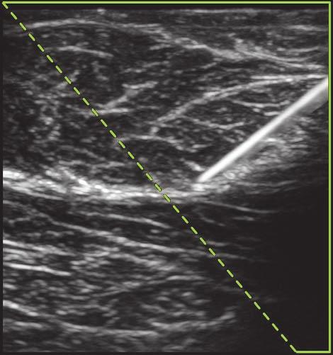X-Porte har tekniken Steep Needle Profiling, som kan underlätta nålguidning vid placering av kateter och vid nervblockad.