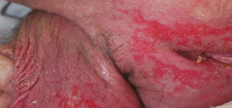 Foto av patient Dag 2 Dag 4 Cavilon Advanced Skin Protectant kan även användas för att: Förebygga IAD hos högriskpatienter och personer som bor på vårdhem