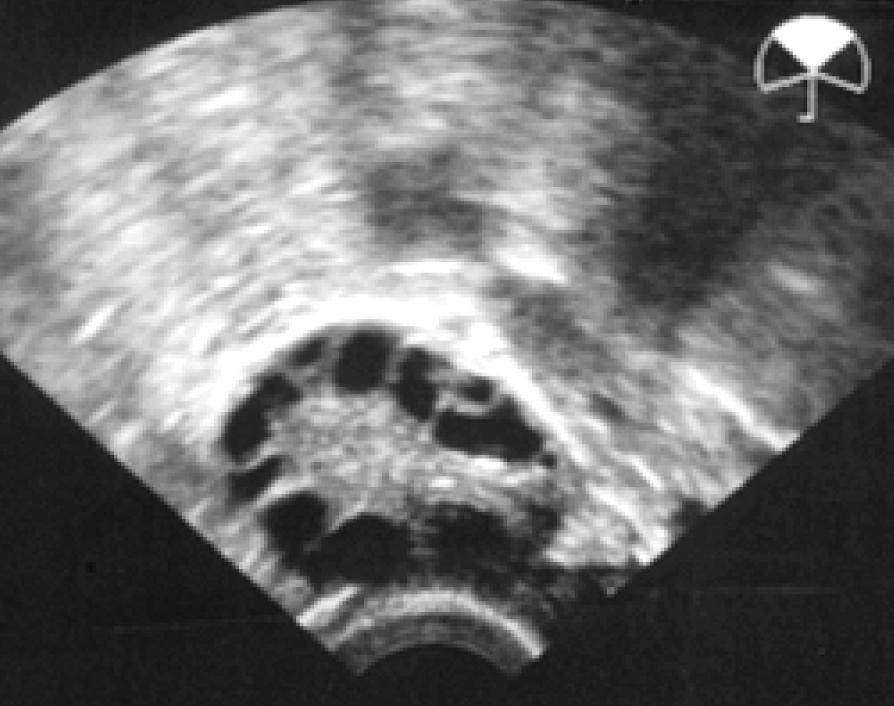 ANGELICA LINDÉN HIRSCHBERG, PIA HEDBERG, SABINE NAESSÉN Figur 1. Typisk ultraljudsbild av ett polycystiskt ovarium.