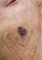 Lentigo maligna och invasiva lentigo maligna melanom ses i senare åldrar och är sällsynta före 40 års ålder.
