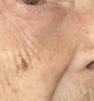 103-årig kvinna. Kommit för uppföljning av en basalcellscancer vid ögat.