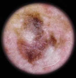 Dermatoskopi: Hos äldre där seborrhoiska keratoser och lentigo solaris är vanliga försvårar sådana kombinationer diagnostiken.