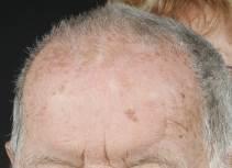 Fall 9. 80-årig man. Huden undersökt i samband med basalcellscancer.