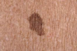 nevus of the elderly of Kossard i