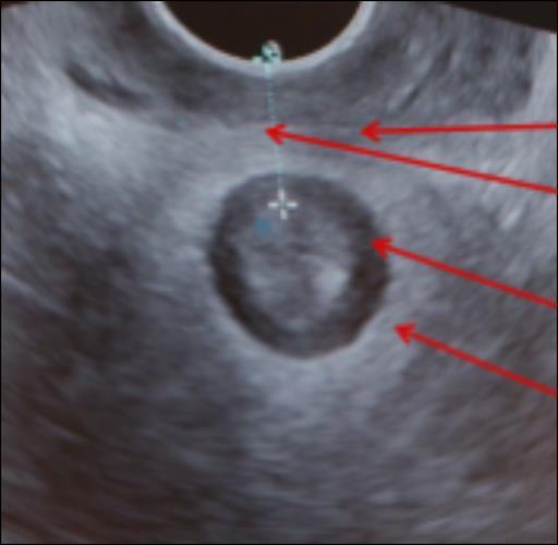 Vaginalt/transperinealt ultraljud, normala ändtarmsmuskler och mellangård Tvärgående