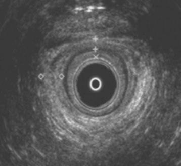 Endoanalt ultraljud, normala ändtarmsmuskler och mellangård.