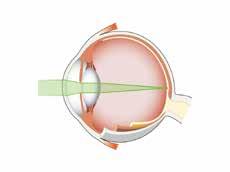 Astigmatism Visste du att? Varför har en person astigmatism?