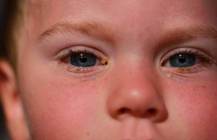 4 Ögoninfektion - snuva i ögat Oftast en del av en förkylning Kletig gul vätska Röda