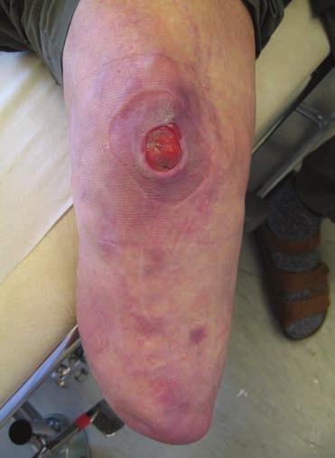 2. RODNAD / IRRITATION PÅ PATELLA TROLIGA ORSAKER TRYCK FRIKTION RÖRELSERELATERAT KAN BERO PÅ: Linerns sträckkraft