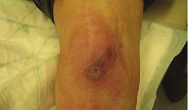 rulla på linern med knät i lätt flekterat läge så att sträckkraften över patella minskar.