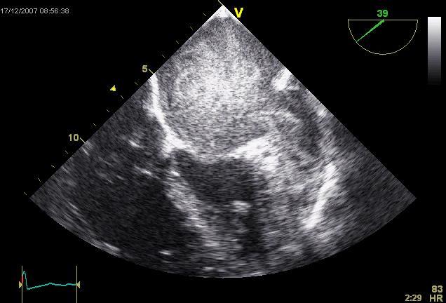 FF med långsamt flöde skapar ett miljö med ökad risk för trombusbildning I vä förmak Stas-relaterad vä förmakstromb är prediktor for TIA och iskämisk TIA 1 och stroke 2.