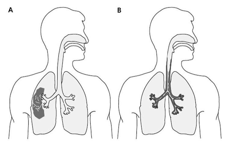 Vad orsakar pneumoni och bronkit?