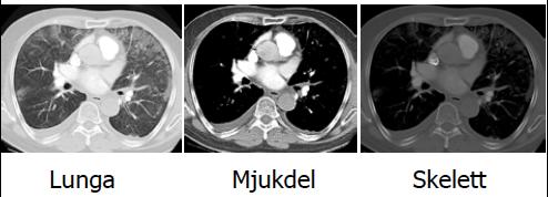 Spiral CT: När detta kom var det mycket märkvärdigt, eftersom man förr var tvungen att göra ett varv, kyla ned maskinen och sen göra ett nytt varv. Idag är all datortomografi i princip spiral CT.