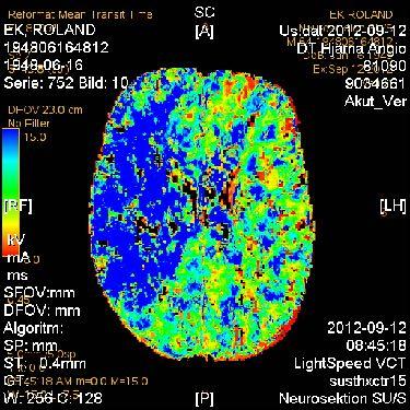 Flow (CBF) ml/100g/min