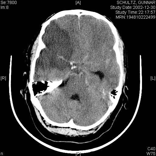 Malign mediainfarkt