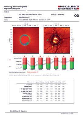 Figur 4 Utskrift från Heidelberg Retina Tomograph med Moorfields regression analysis fiberlagrets tjocklek.