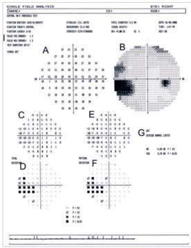 dor i synfältet är Humphreys Glaucoma Hemifield Test (Fig. 6G), eller Octopus kumulativa defektkurva (Fig. 6H).