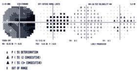 Eventanalyser I Humphrey-perimeterns Glaucoma Change Probability Maps (Fig. 7). flaggas testpunkter (trianglar) som försämrats signifikant (p<5%), d.v.s. testpunkter som försämrats mer än vad som förväntas av den slumpmässiga test-retest variabiliteten.