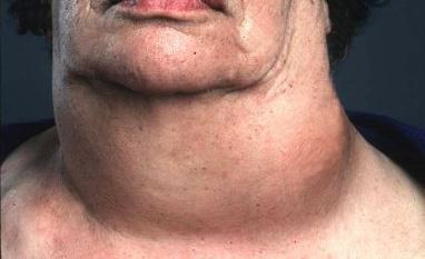 1. Akuta cancersjukdomar Testikelcancer