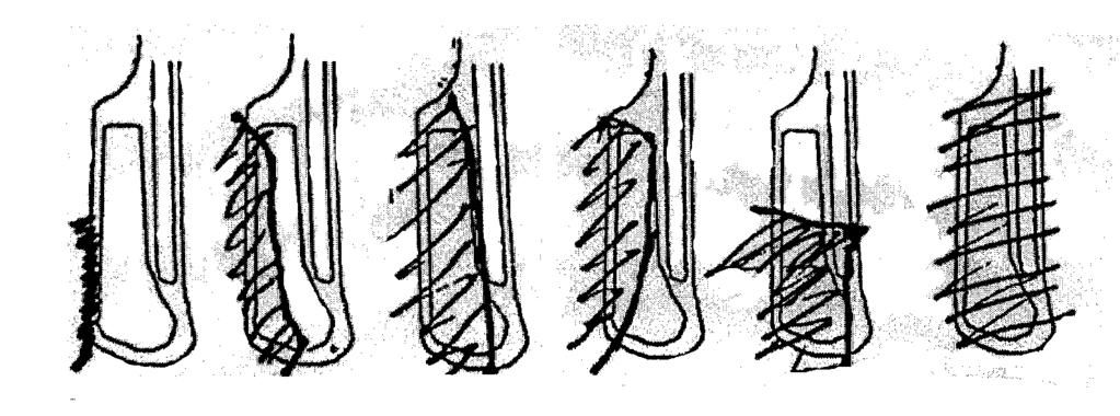 PRIMÄRT OMHÄNDERTAGANDE A B C D E F Figur 7. Typexempel på skador. A Bristning av endast vaginalslemhinnan.