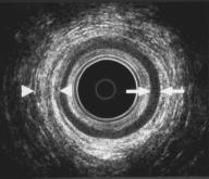 Ultraljud av analsfinktern, Endoanalt ultraljud HUVUDANSVARIGA FÖRFATTARE: Staffan Bremmer och Jan Zetterström Bakgrund Genom att en cirkulärt roterande ultraljudsprob framtagits för rektalt bruk, så