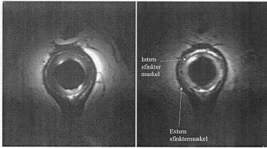 LENNART BLOMQVIST OCH STAFFAN BREMMER T1-viktad bild T2-viktad bild Transversella magnetkamerabilder av analkanalen på frisk försöksperson med endoanal spolprototyp. Figur 1.