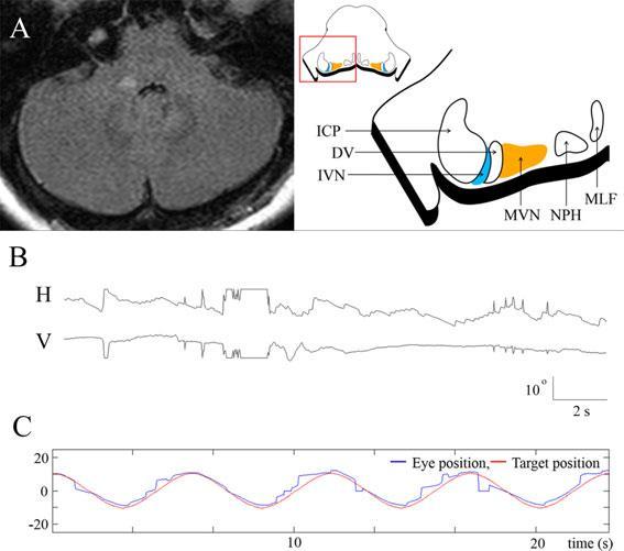 paroxysmal positionell nystagmus.