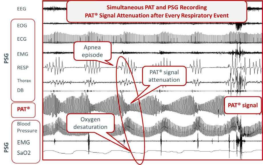 PAT Perifer Arteriell Tonometri Perifer