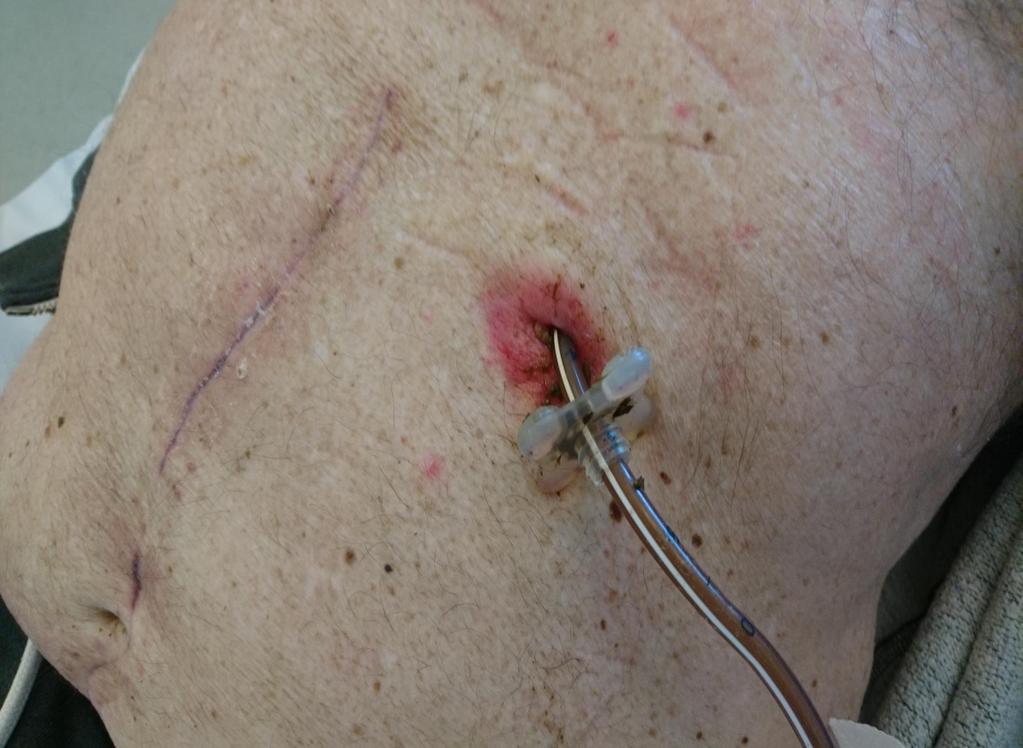 Operativt ( laparatomi) lagd gastrostomi.